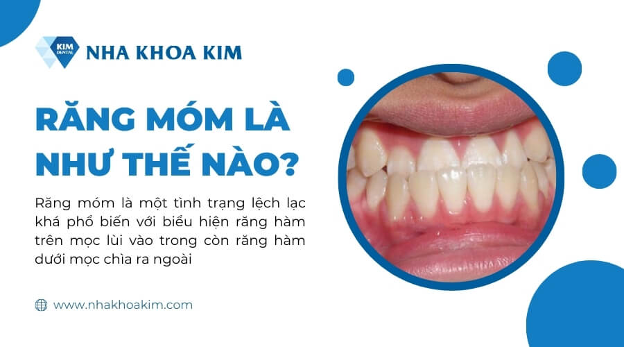 Răng móm là như thế nào? 