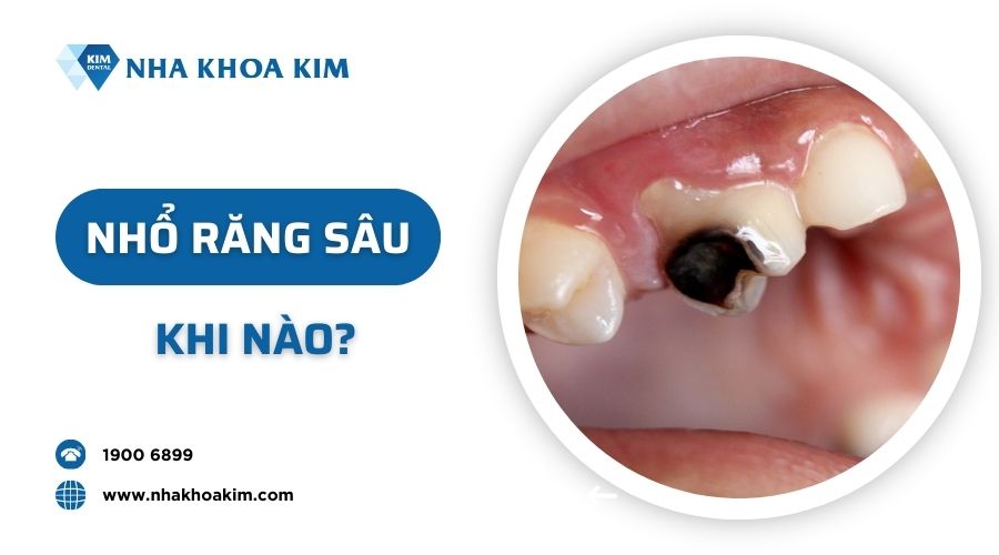 Răng sâu như thế nào thì phải nhổ?