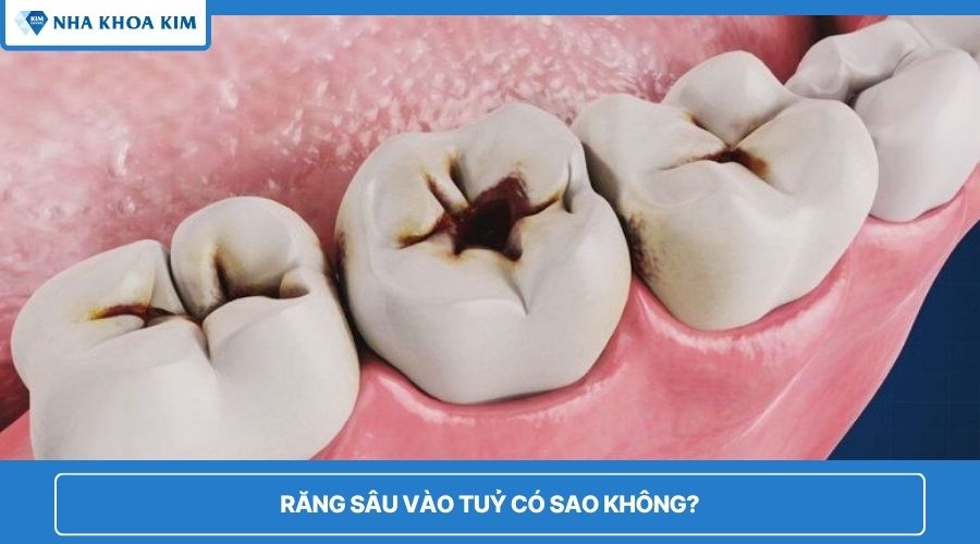 răng sâu vào tủy có sao không