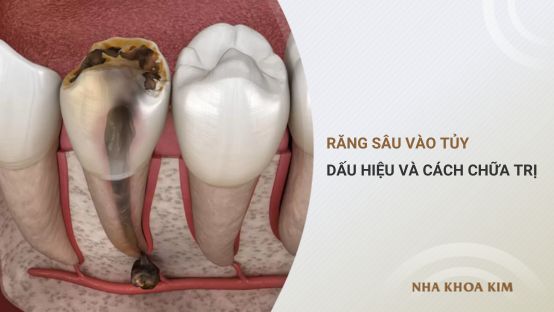 Răng sâu vào tủy – Dấu hiệu nhận biết và cách chữa trị hiệu quả