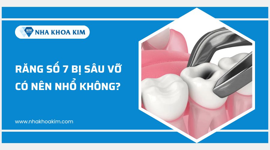 răng số 7 bị sâu vỡ có nên nhổ không