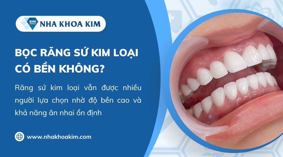 bọc răng sứ kim loại có bền không
