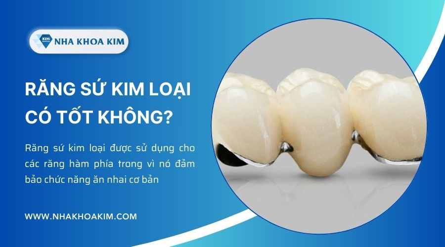 bọc răng sứ kim loại có tốt không