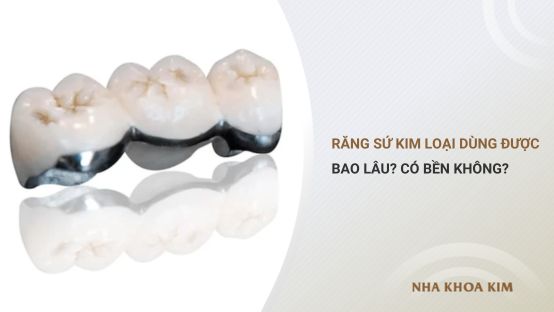 Răng sứ kim loại dùng được bao lâu? Răng sứ kim loại có bền không?