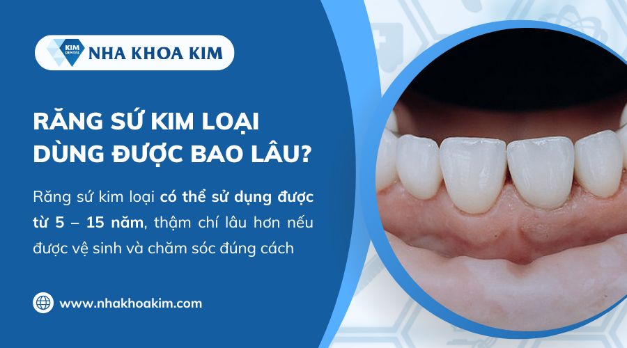 răng sứ kim loại dùng được bao lâu