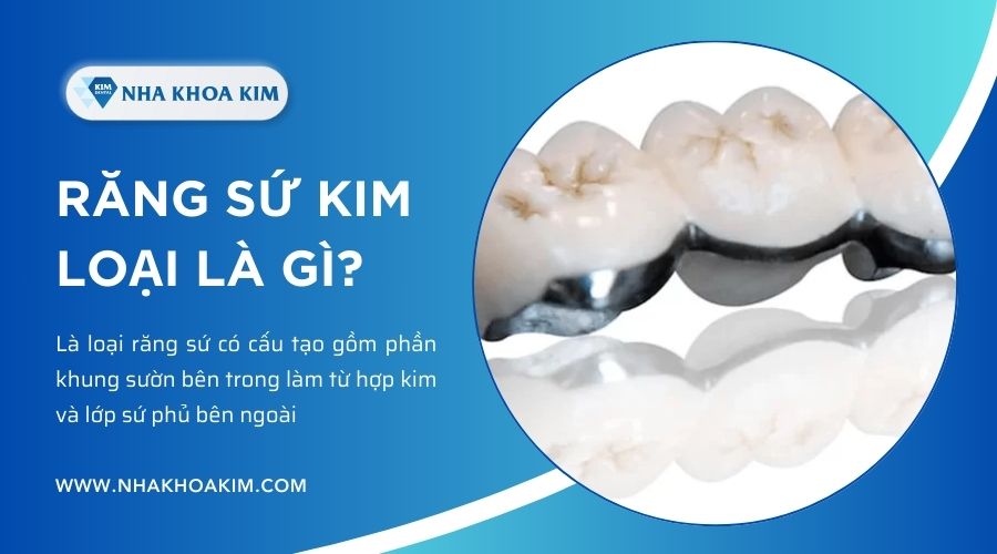 răng sứ kim loại là gì