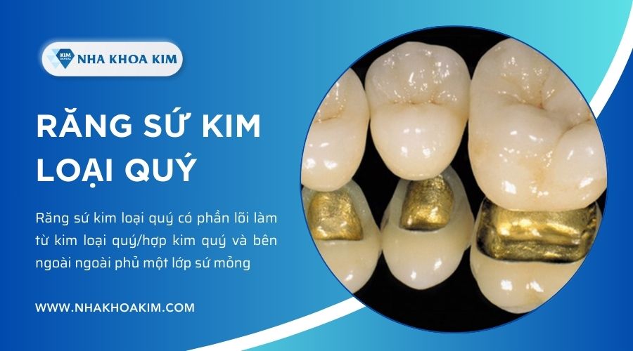 răng kim loại quý