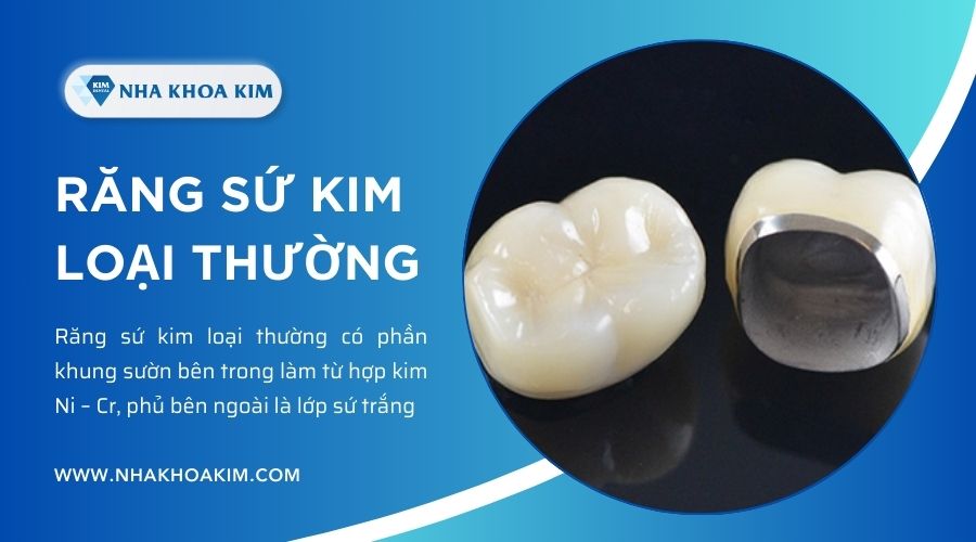 răng sứ kim loại thường