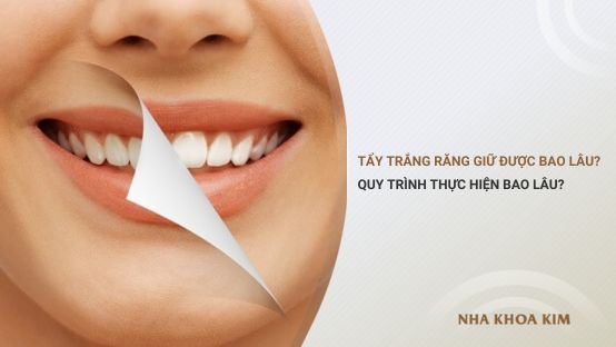 Tẩy trắng răng giữ được bao lâu? Quy trình thực hiện mất bao lâu?