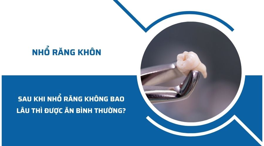 Nhổ răng khôn bao lâu thì ăn được? Cách giảm đau khi ăn