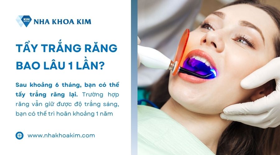 tẩy trăng răng bao lâu 1 lần