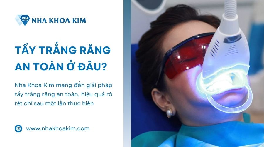 tẩy trắng răng tại nha khoa kim