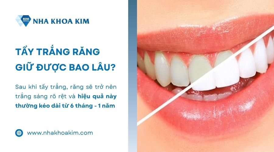 tẩy trắng răng giữ được bao lâu