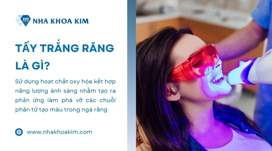 tẩy trắng răng là gì?