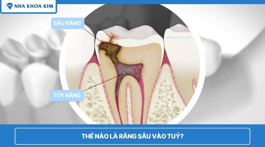 thế nào là răng sâu vào tủy