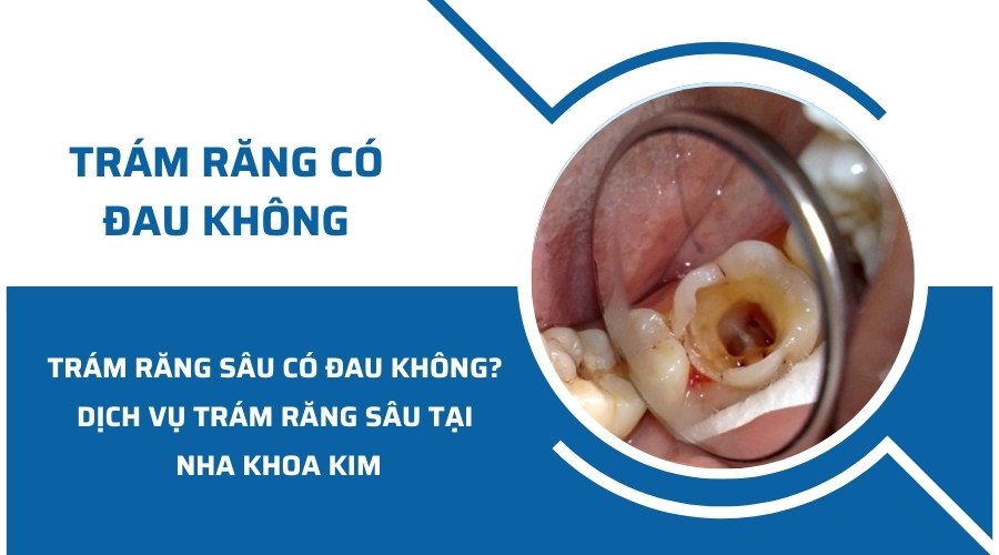 Trám răng sâu có đau không? Địa chỉ trám răng sâu hiệu quả, an toàn