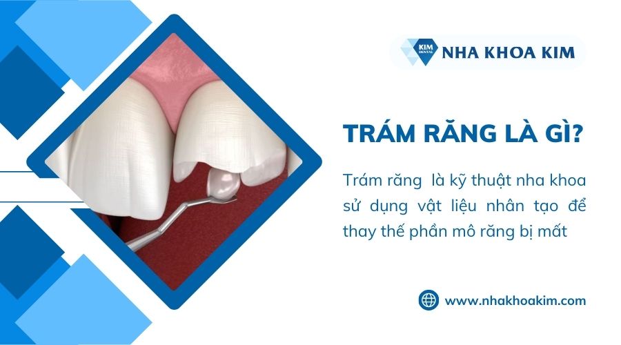 trám răng là gì?