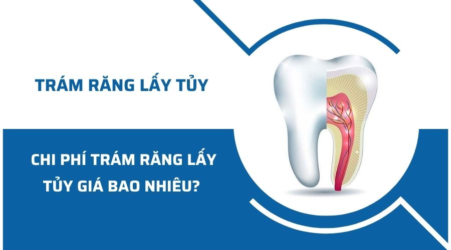 Chi phí trám răng lấy tủy giá bao nhiêu tại Nha khoa Kim
