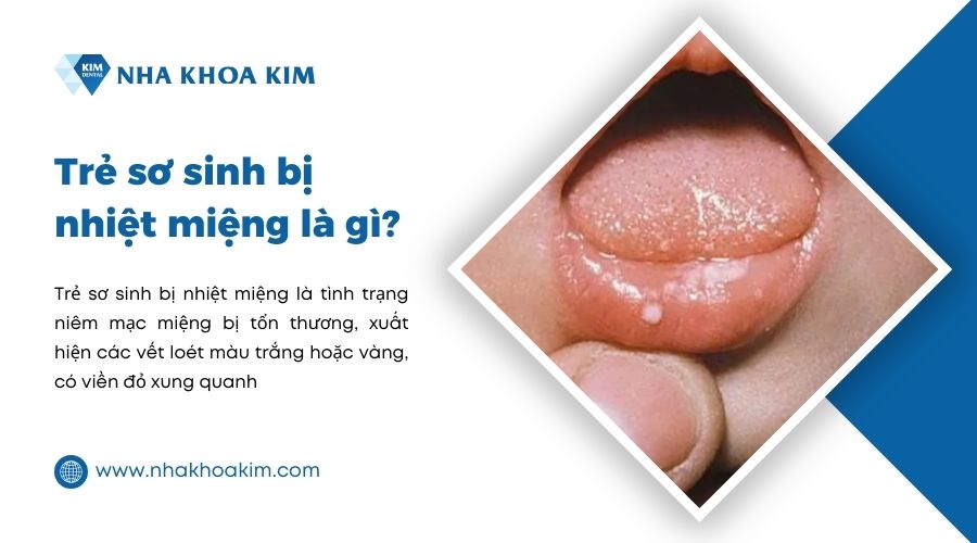 trẻ sơ sinh bị nhiệt miệng là gì