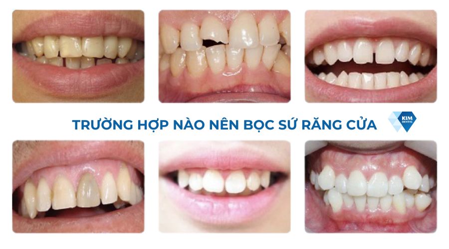 Trường hợp nào nên bọc sứ răng cửa?