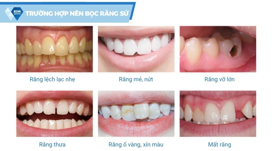 các trường hợp nên bọc răng sứ