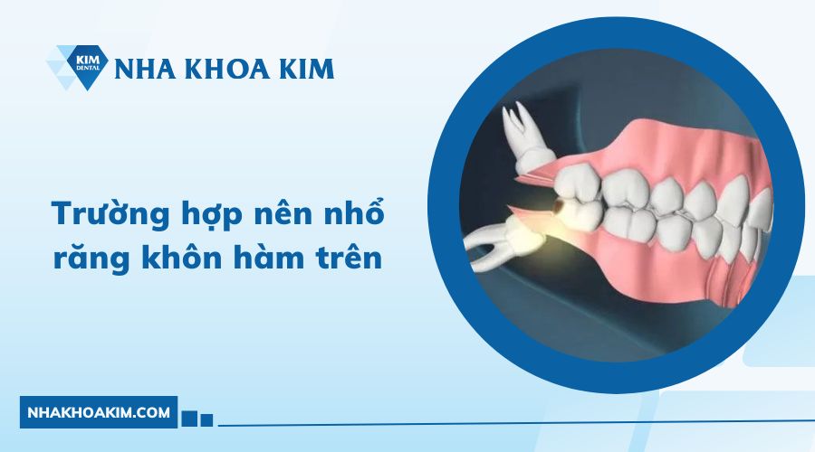 Trường hợp nên nhổ răng khôn hàm trên