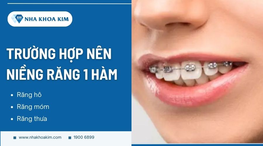 Nên niềng răng 1 hàm khi nào?