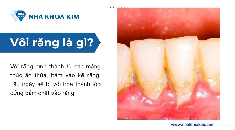 vôi răng là gì?