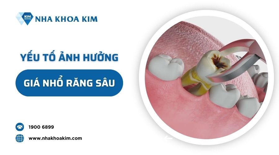 Yếu tố ảnh hưởng đến giá nhổ răng sâu