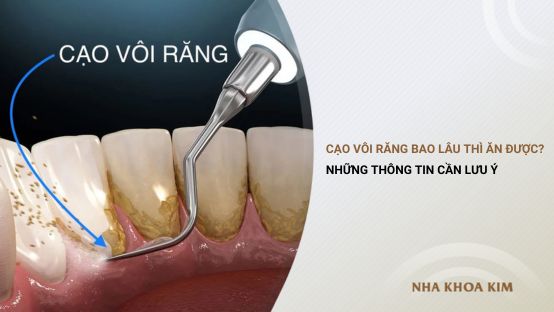Cạo vôi răng bao lâu thì ăn được? Những thông tin cần lưu ý