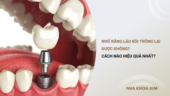 Nhổ răng lâu rồi trồng lại được không? Cách nào hiệu quả nhất?