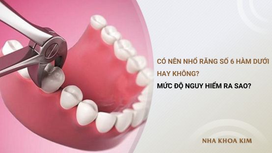 Có nên nhổ răng số 6 hàm dưới hay không? Mức độ nguy hiểm ra sao?