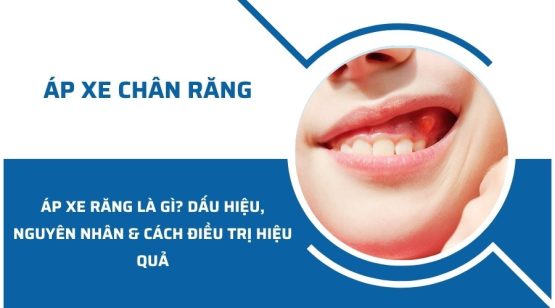 Bị áp xe răng là gì? Dấu hiệu, nguyên nhân và hướng điều trị