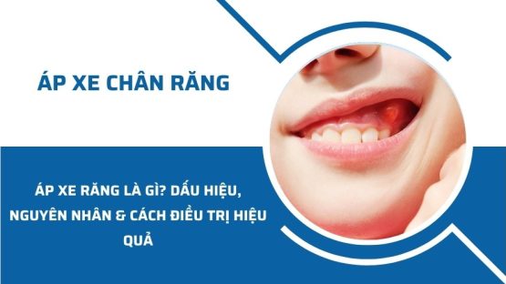 Bị áp xe răng là gì? Dấu hiệu, nguyên nhân và hướng điều trị