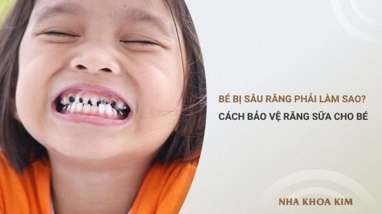 Bé bị sâu răng phải làm sao? Cách bảo vệ răng sữa cho bé