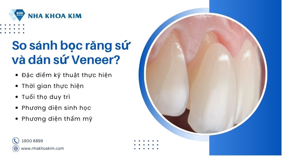so sánh bọc sứ và dán sứ