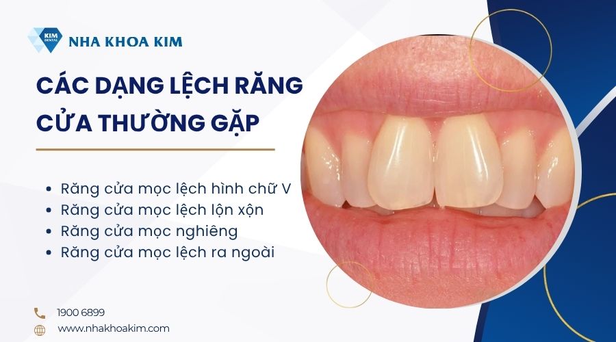 Các dạng lệch răng cửa