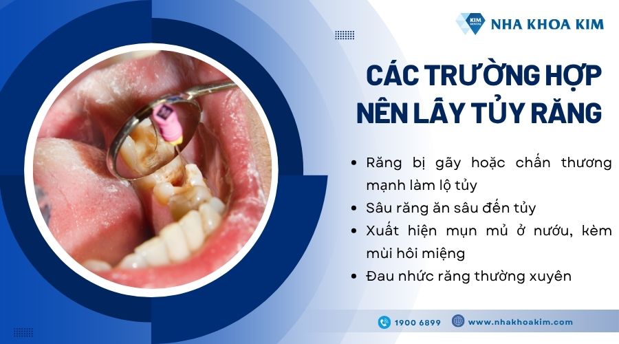 Các trường hợp nên lấy tủy răng