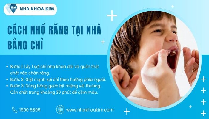 nhổ răng tại nhà bằng chỉ