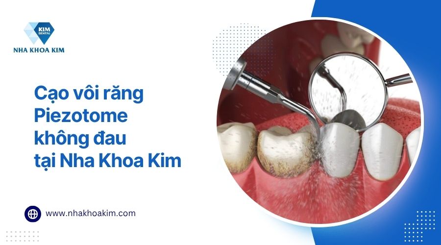 Công nghệ cạo vôi răng Piezotome không đau tại Nha Khoa Kim