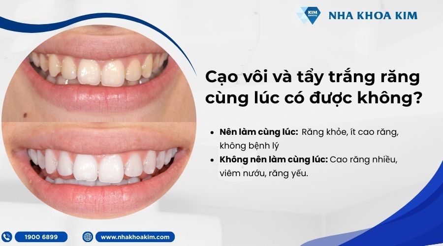 cạo vôi răng và tẩy trắng răng cùng lúc có được không