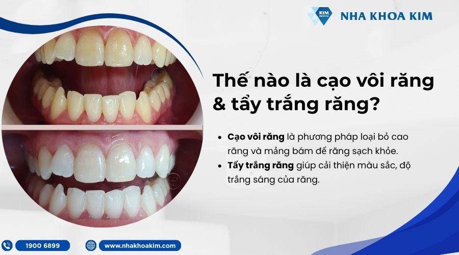 cạo vôi răng và tẩy trắng răng là gì
