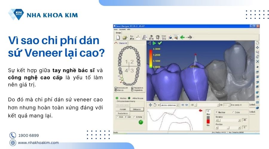 vì sao chi phí dán sứ veneer cao