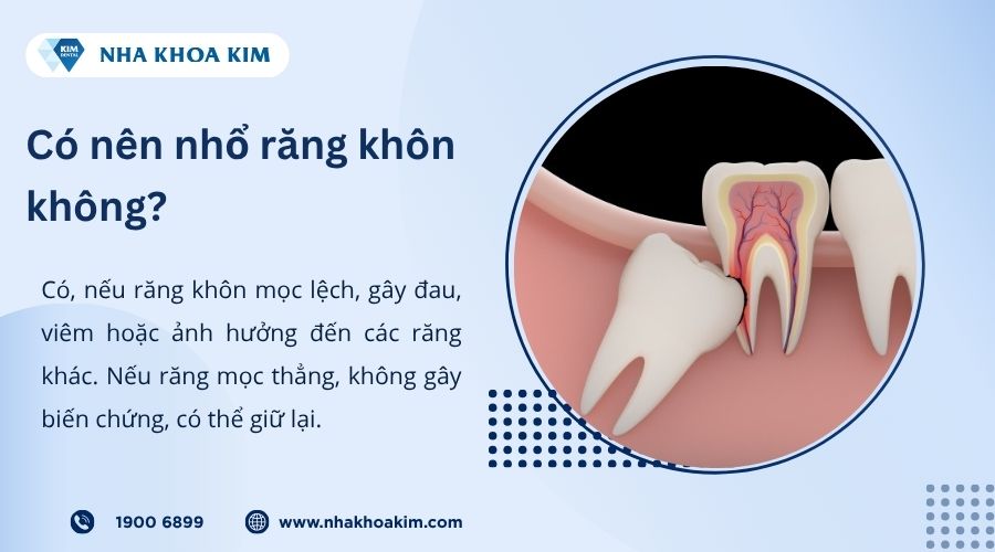 Có nên nhổ răng khôn không