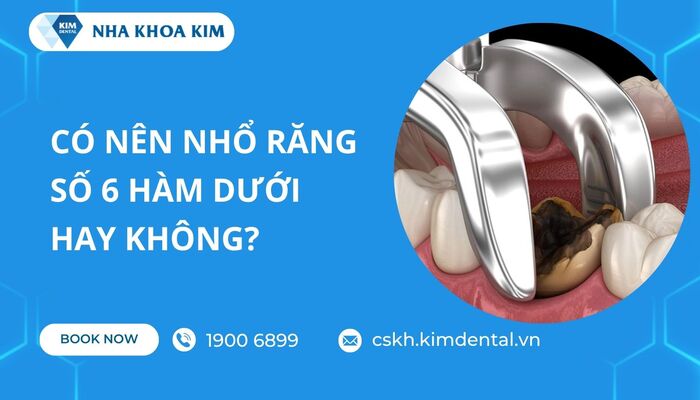 có nên nhổ răng số 6 hàm dưới không