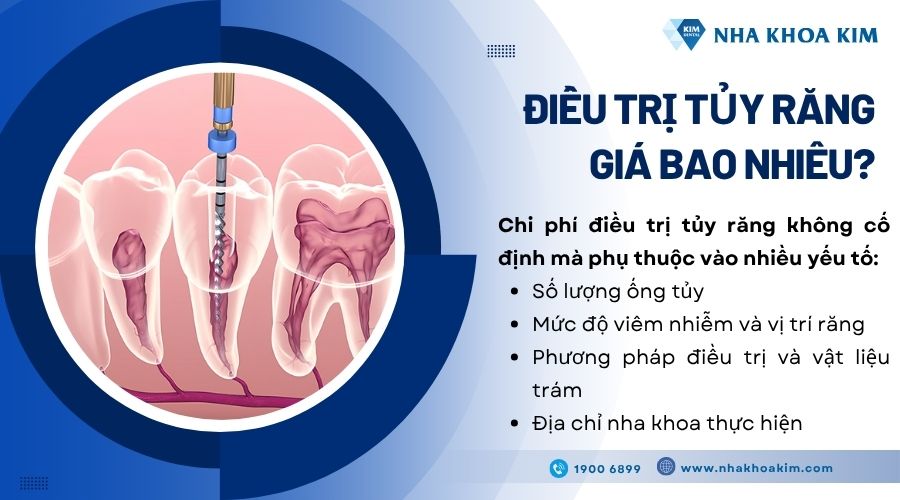 điều trị tủy răng giá bao nhiêu tiền