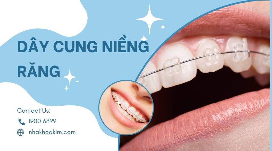 Dây cung niềng răng