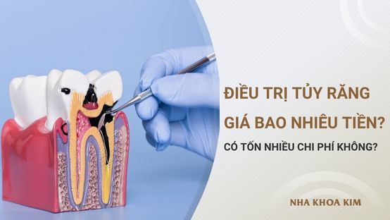 Điều trị tủy răng giá bao nhiêu tiền, có mất nhiều chi phí không?