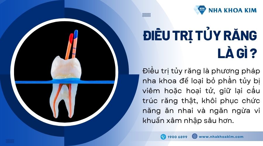 Điều trị tủy răng là gì