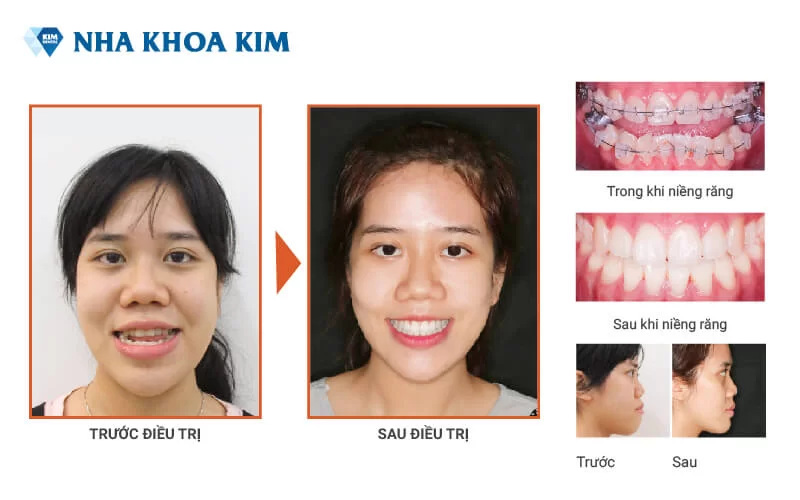 Khách hàng niềng răng kết hợp phẫu thuật